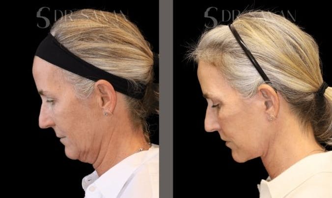 Deep Plane Facelift Before & After Gallery - Patient 332719 - Image 4