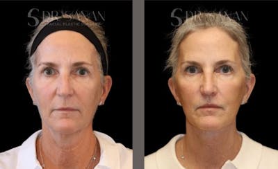 Deep Plane Facelift Before & After Gallery - Patient 332719 - Image 1