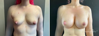 Breast Augmentation Before & After Gallery - Patient 386897 - Image 1