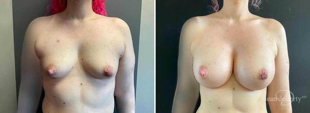 Breast Augmentation Before & After Gallery - Patient 386897 - Image 1