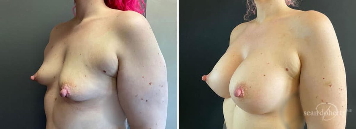 Breast Augmentation Before & After Gallery - Patient 386897 - Image 1