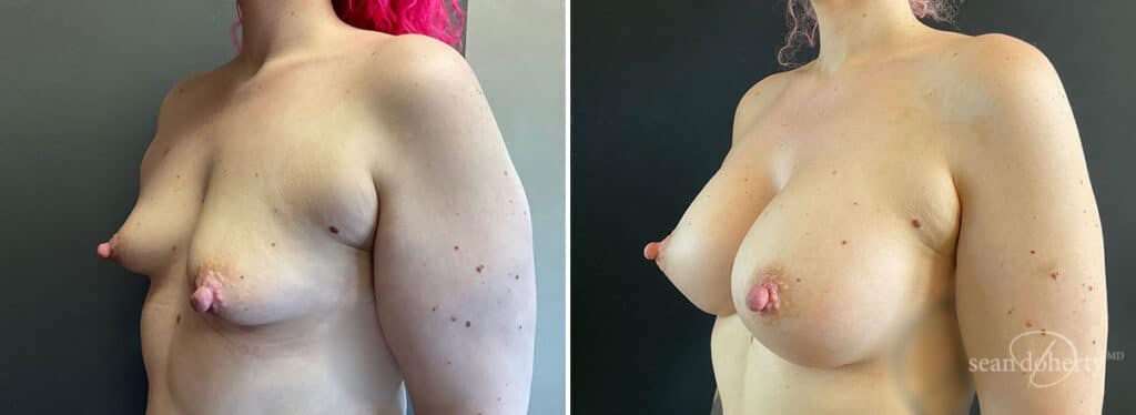 Breast Augmentation Before & After Gallery - Patient 386897 - Image 2
