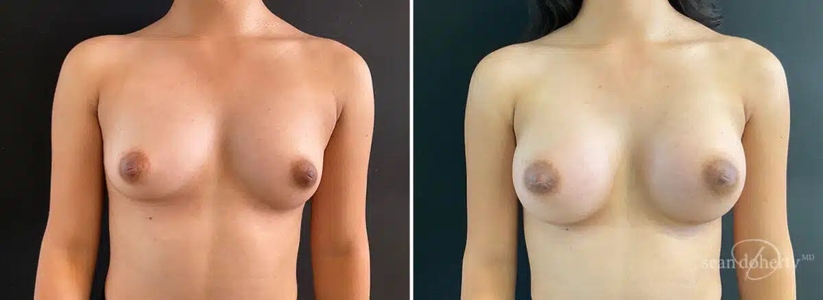 Breast Augmentation Before & After Gallery - Patient 400956 - Image 1
