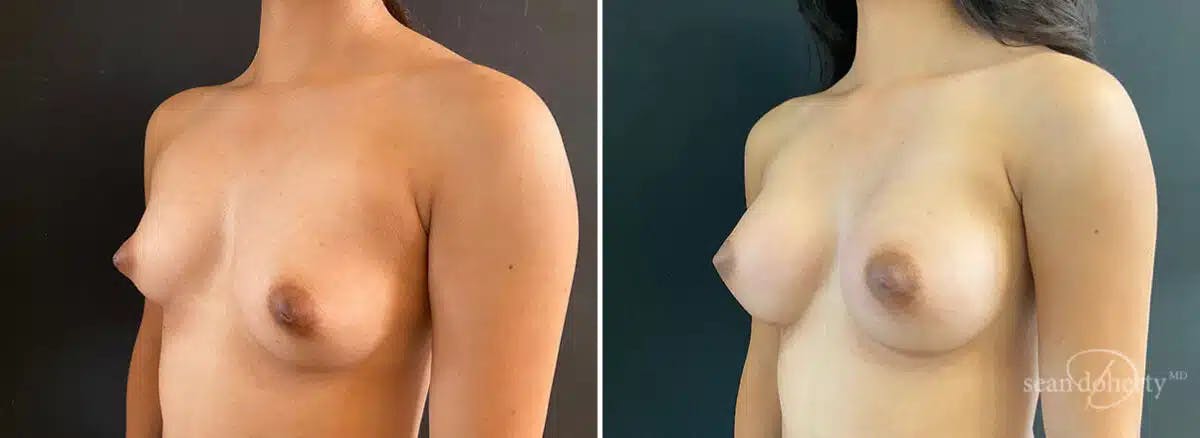 Breast Augmentation Before & After Gallery - Patient 400956 - Image 2