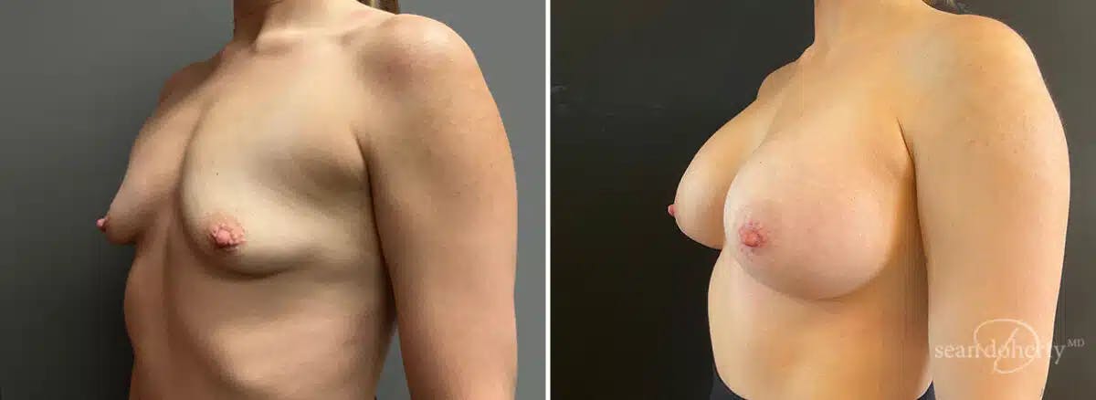 Breast Augmentation Before & After Gallery - Patient 128610 - Image 2