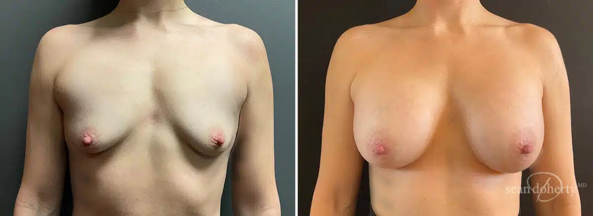Breast Augmentation Before & After Gallery - Patient 128610 - Image 1