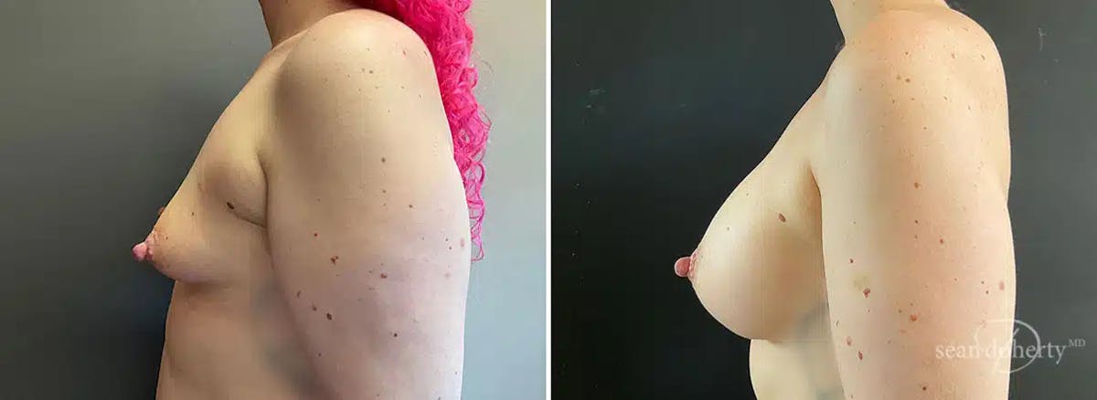 Breast Augmentation Before & After Gallery - Patient 386897 - Image 3