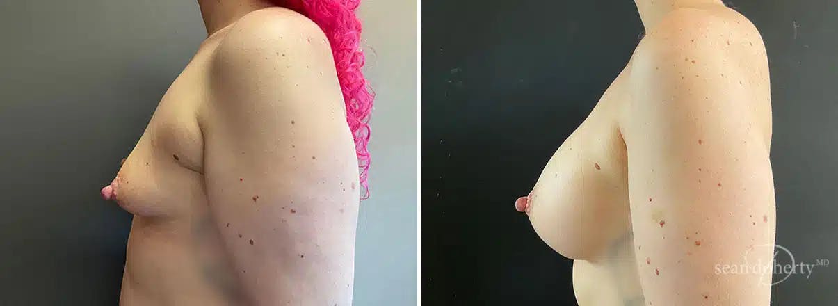 Breast Augmentation Before & After Gallery - Patient 386897 - Image 3