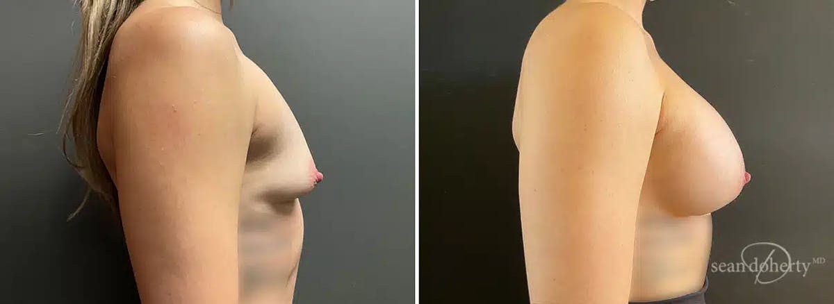 Breast Augmentation Before & After Gallery - Patient 128610 - Image 3