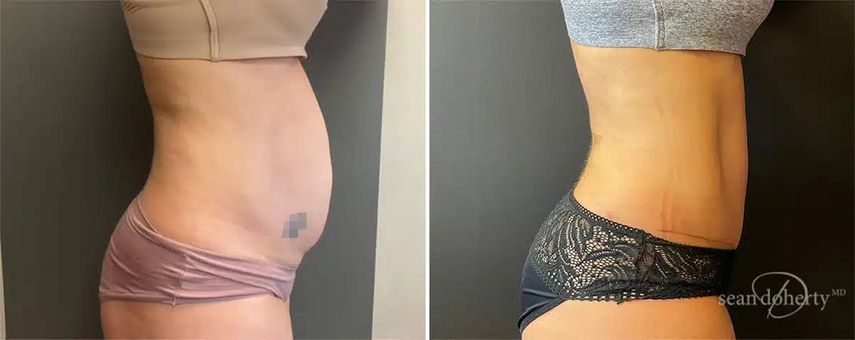 Abdominoplasty (Tummy Tuck) Before & After Gallery - Patient 181106 - Image 1
