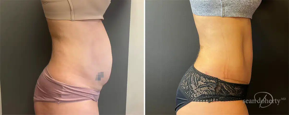 Abdominoplasty (Tummy Tuck) Before & After Gallery - Patient 181106 - Image 1