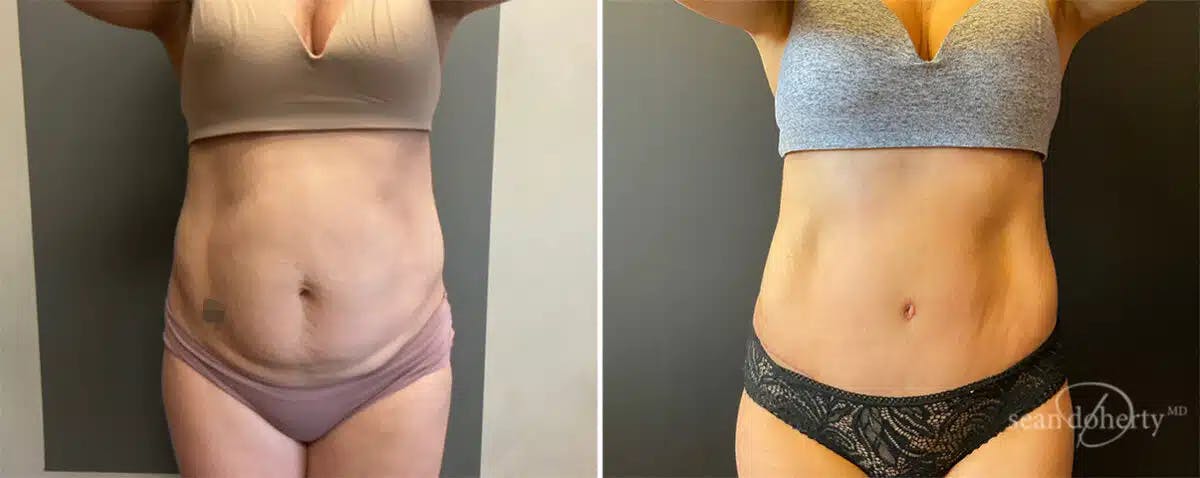 Abdominoplasty (Tummy Tuck) Before & After Gallery - Patient 181106 - Image 3