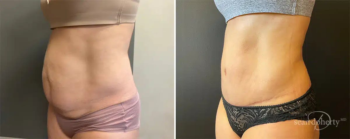 Abdominoplasty (Tummy Tuck) Before & After Gallery - Patient 181106 - Image 2