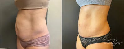 Abdominoplasty (Tummy Tuck) Before & After Gallery - Patient 181106 - Image 2