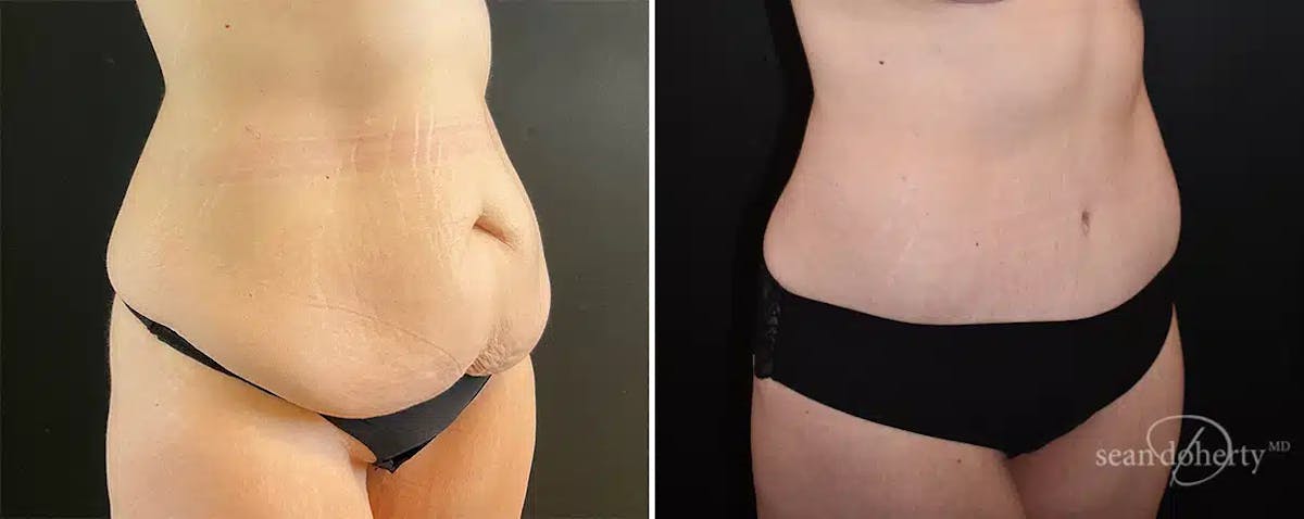 Abdominoplasty (Tummy Tuck) Before & After Gallery - Patient 248129 - Image 2