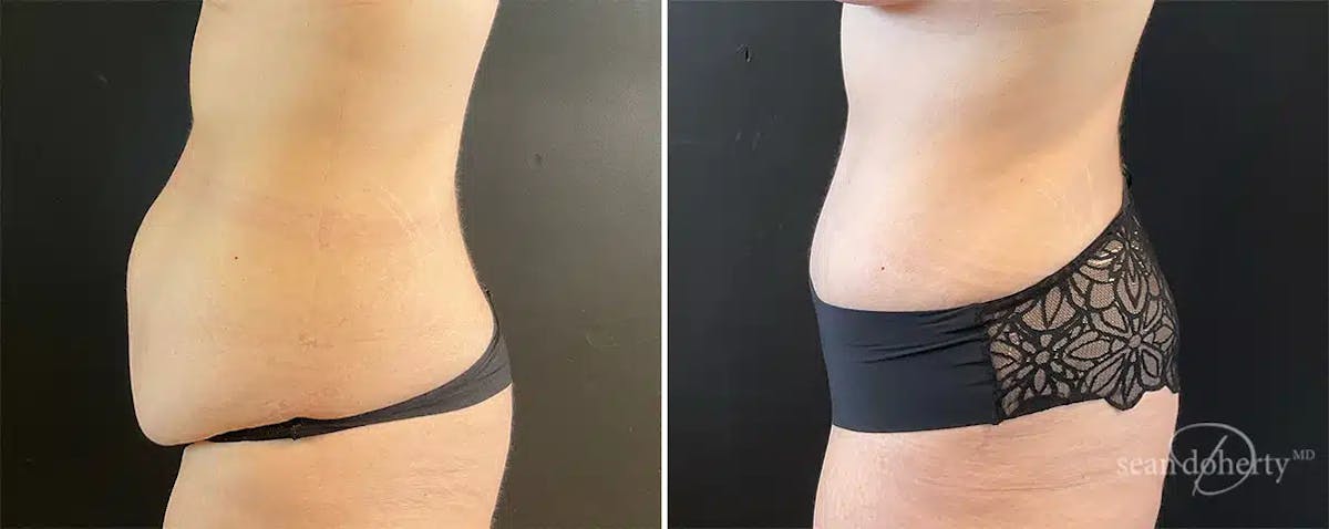 Abdominoplasty (Tummy Tuck) Before & After Gallery - Patient 248129 - Image 3