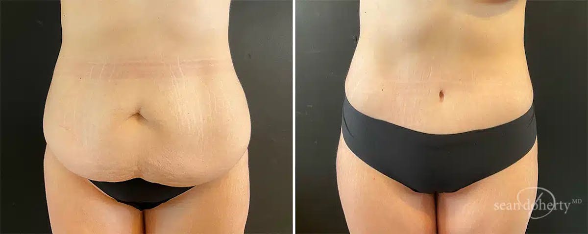 Abdominoplasty (Tummy Tuck) Before & After Gallery - Patient 248129 - Image 1