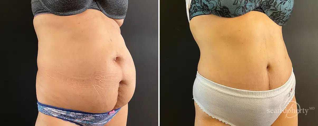 Abdominoplasty (Tummy Tuck) Before & After Gallery - Patient 324546 - Image 2