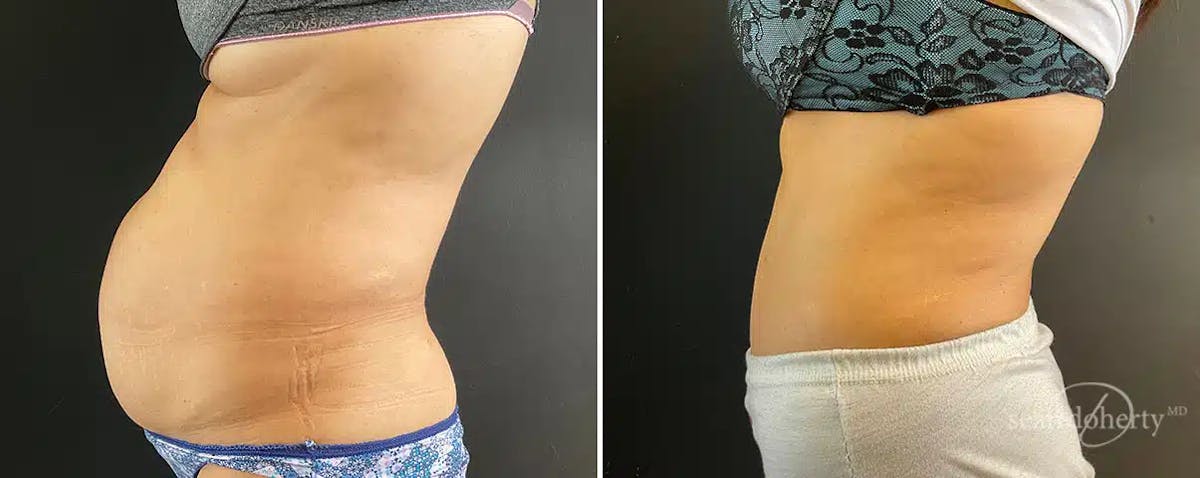 Abdominoplasty (Tummy Tuck) Before & After Gallery - Patient 324546 - Image 2