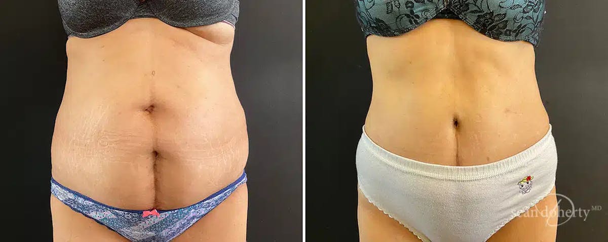 Abdominoplasty (Tummy Tuck) Before & After Gallery - Patient 324546 - Image 3
