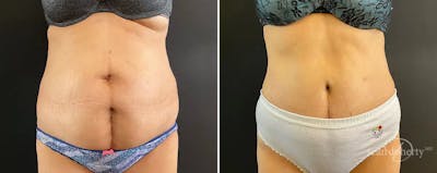 Abdominoplasty (Tummy Tuck) Before & After Gallery - Patient 324546 - Image 1