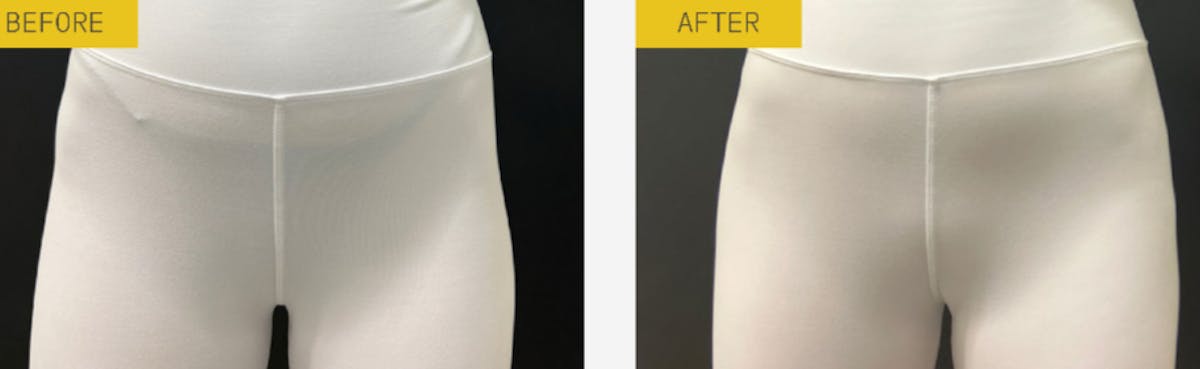 Alloclae Before & After Gallery - Patient 278085 - Image 1