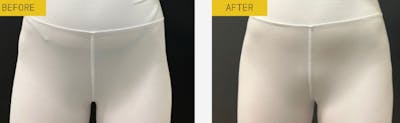 Alloclae Before & After Gallery - Patient 278085 - Image 1