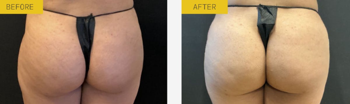 Alloclae Before & After Gallery - Patient 229208 - Image 1