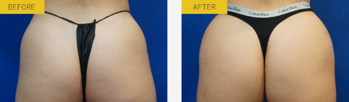 Alloclae Before & After Gallery - Patient 666519 - Image 1