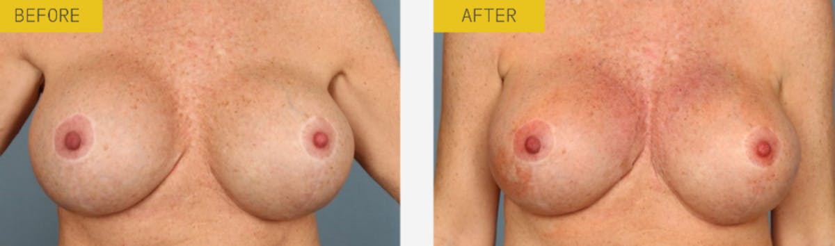 Alloclae Before & After Gallery - Patient 644417 - Image 1