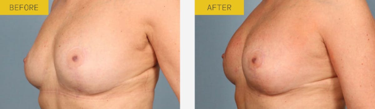 Alloclae Before & After Gallery - Patient 221174 - Image 1