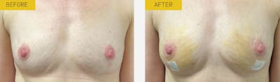 Alloclae Before & After Gallery - Patient 253723 - Image 1