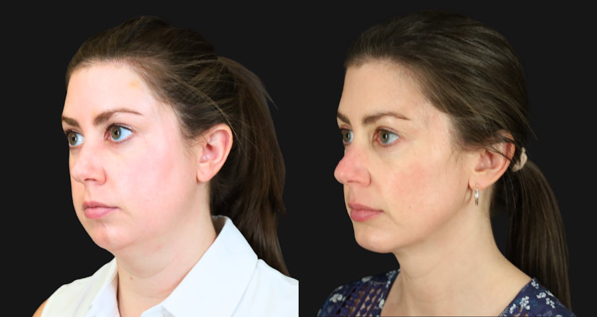 Neck Lift Before & After Gallery - Patient 302284 - Image 1