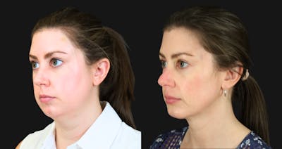 Neck Lift Before & After Gallery - Patient 302284 - Image 1