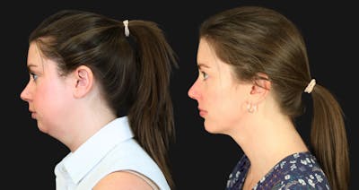 Neck Lift Before & After Gallery - Patient 302284 - Image 1