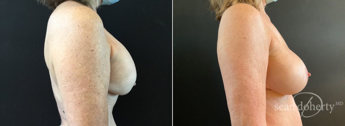 Breast Implant Exchange Before & After Gallery - Patient 114012 - Image 3