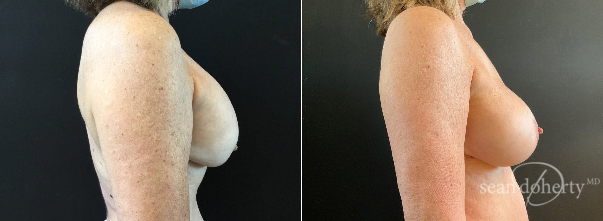 Breast Implant Exchange Before & After Gallery - Patient 114012 - Image 3