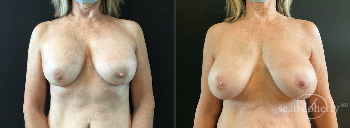 Breast Implant Exchange Before & After Gallery - Patient 114012 - Image 1