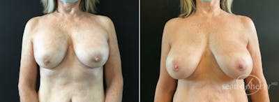 Breast Implant Exchange Before & After Gallery - Patient 114012 - Image 1