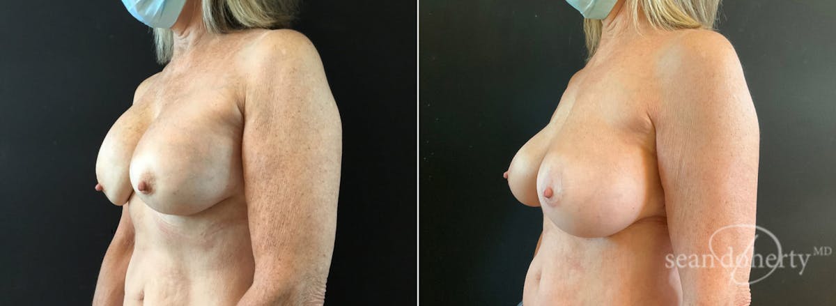 Breast Implant Exchange Before & After Gallery - Patient 114012 - Image 2