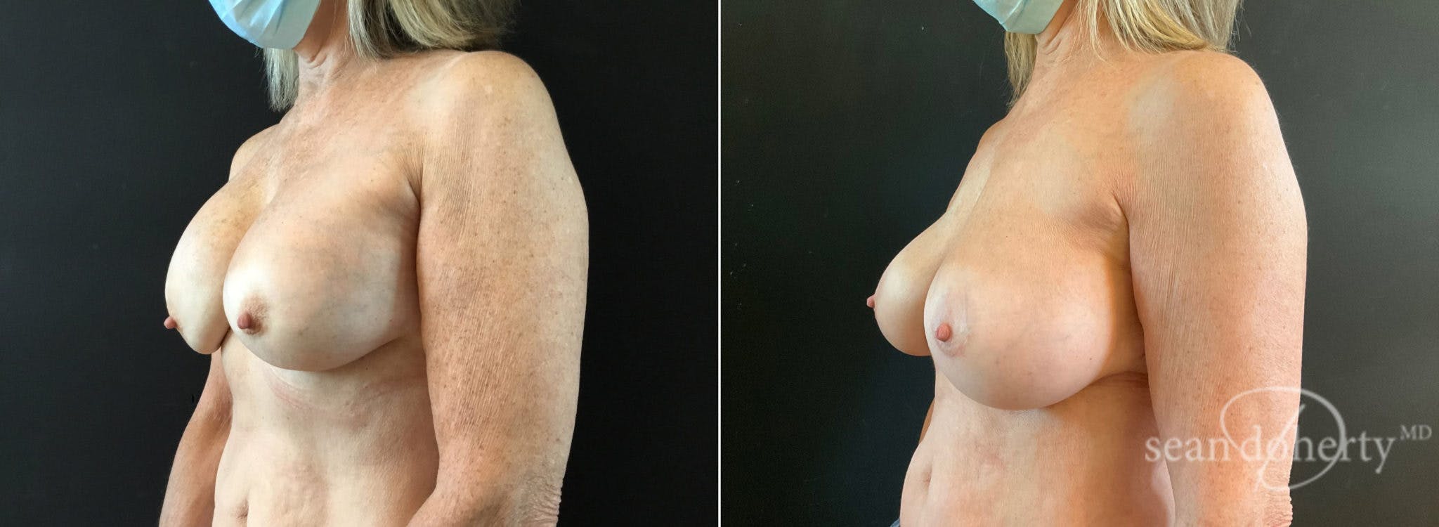 Breast Implant Exchange Before & After Gallery - Patient 114012 - Image 2