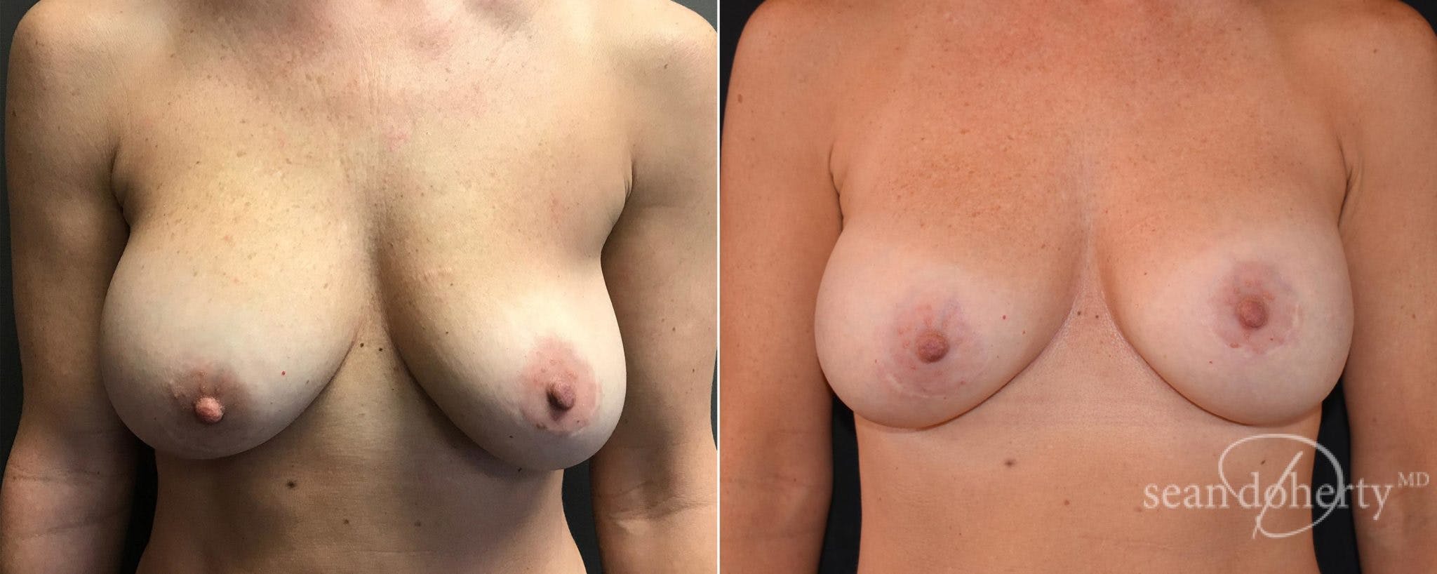Breast Implant Exchange Before & After Gallery - Patient 364886 - Image 1
