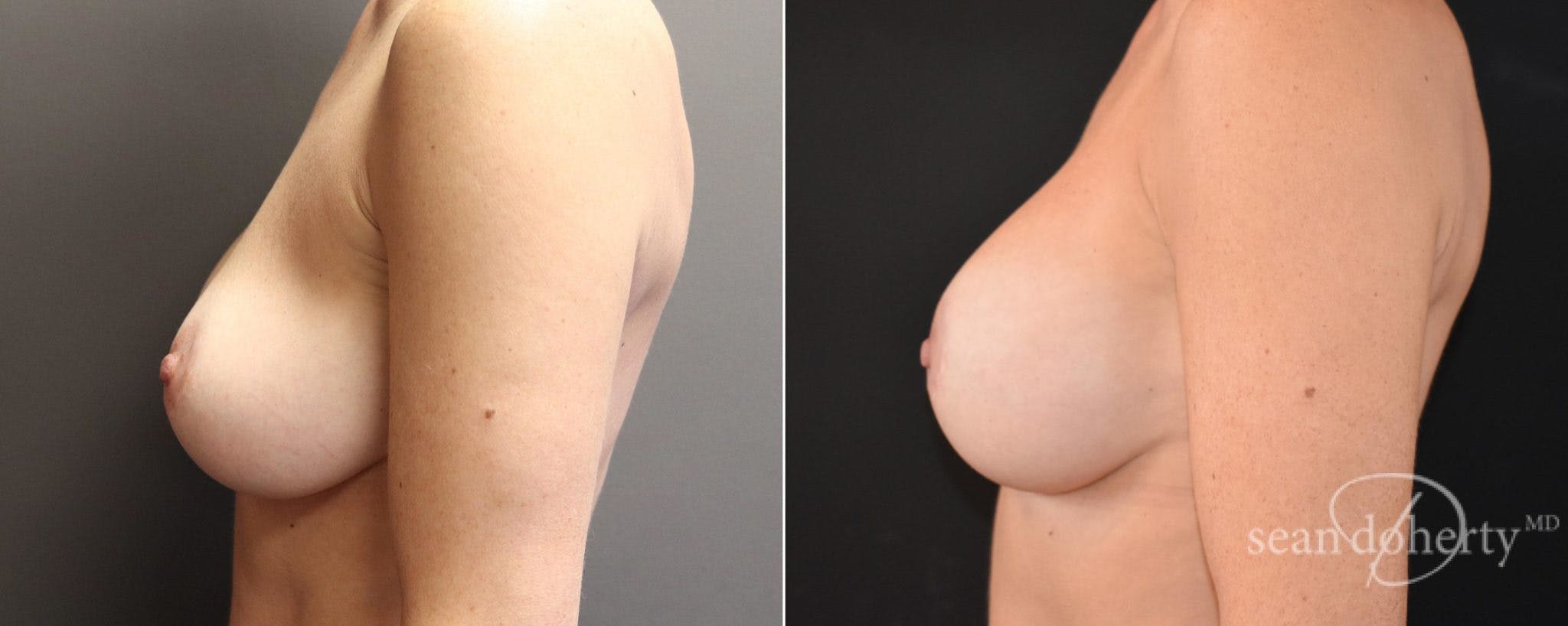 Breast Implant Exchange Before & After Gallery - Patient 364886 - Image 2