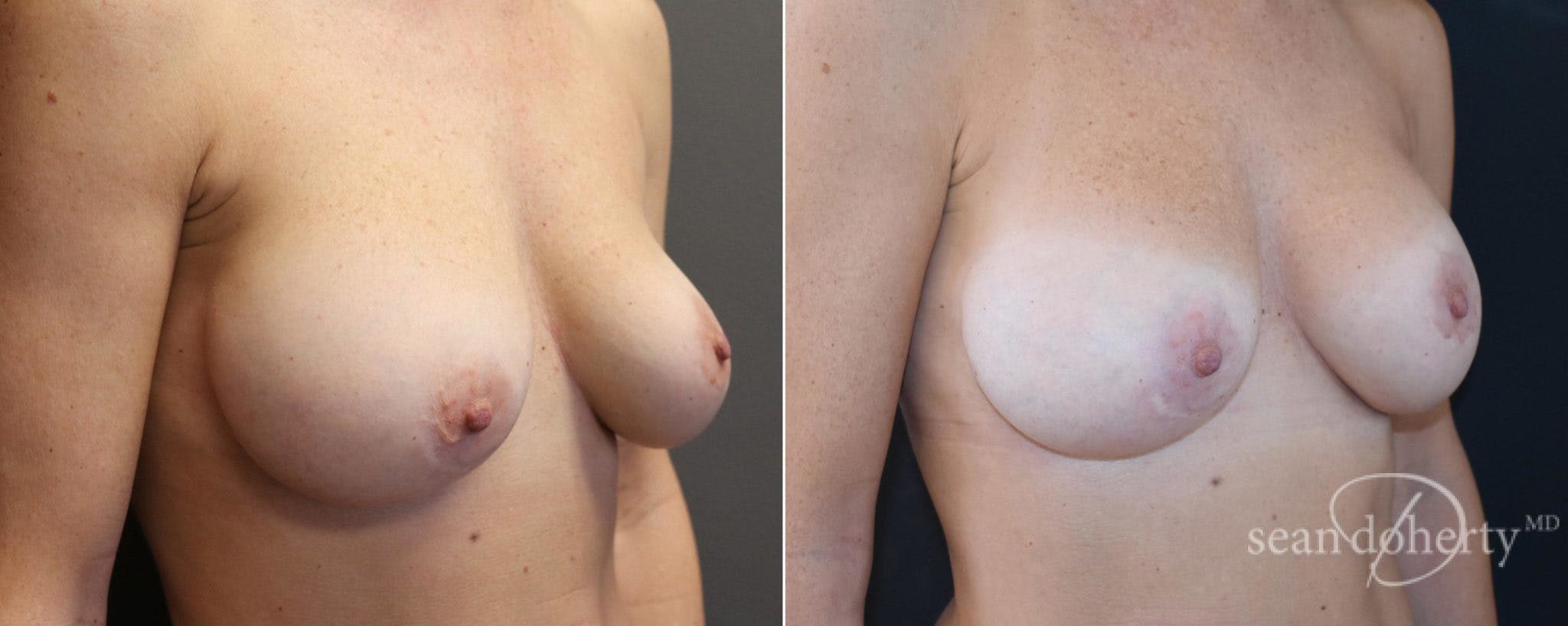 Breast Implant Exchange Before & After Gallery - Patient 364886 - Image 3