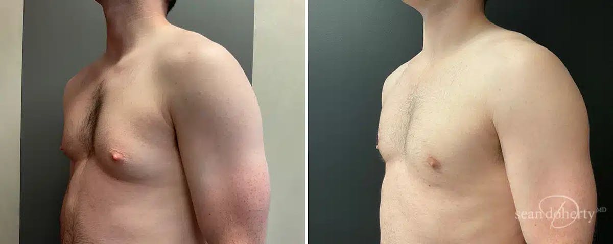 Male Breast Reduction (Gynecomastia) Before & After Gallery - Patient 132996 - Image 2