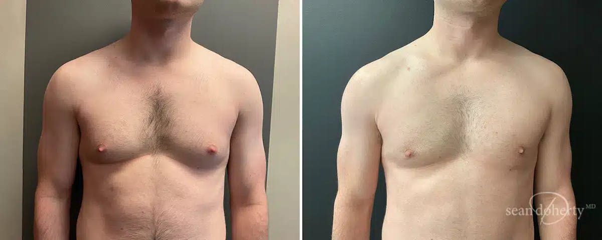 Male Breast Reduction (Gynecomastia) Before & After Gallery - Patient 132996 - Image 1