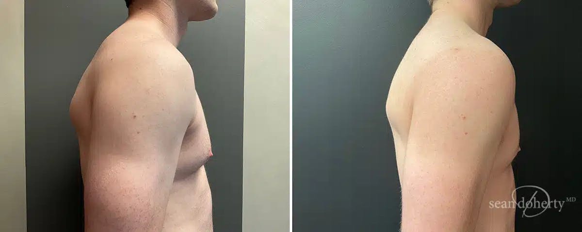 Male Breast Reduction (Gynecomastia) Before & After Gallery - Patient 132996 - Image 3