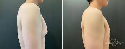Male Breast Reduction (Gynecomastia) Before & After Gallery - Patient 357444 - Image 1