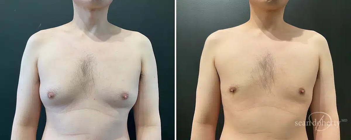 Male Breast Reduction (Gynecomastia) Before & After Gallery - Patient 357444 - Image 3