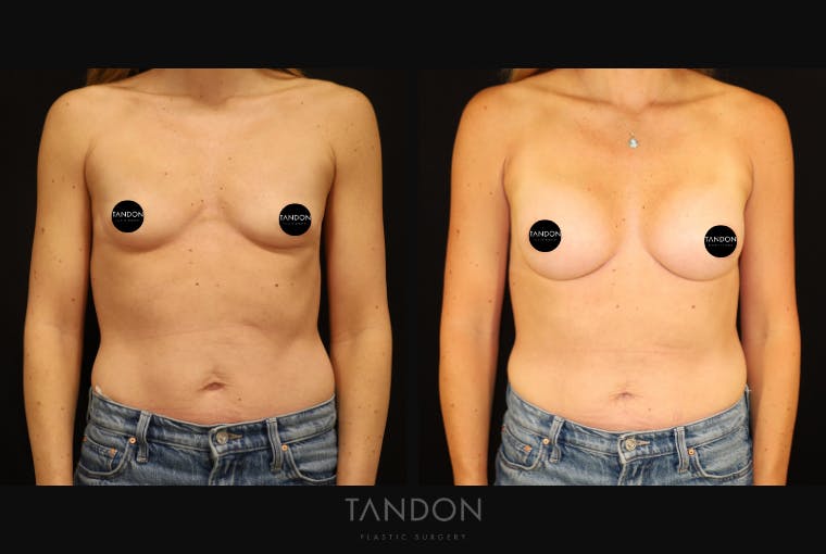 Breast Augmentation Before & After Gallery - Patient 313278 - Image 1